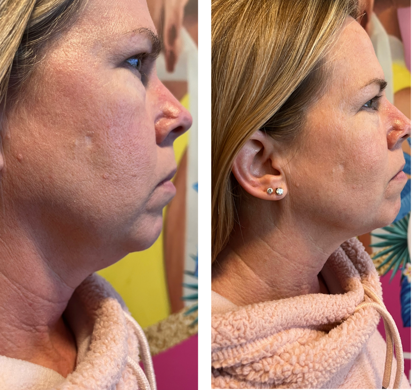 Lipo Burn Treatment